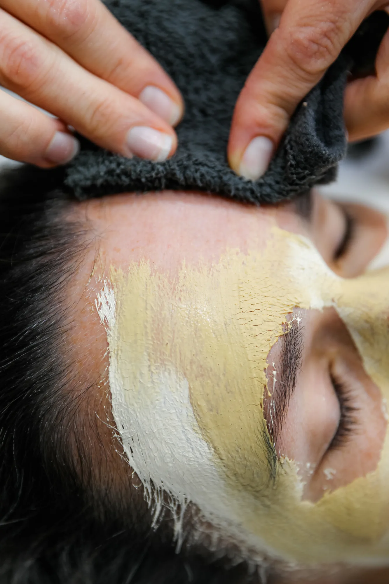 A corneotherapy mask being removed during an acne treatment in Echuca