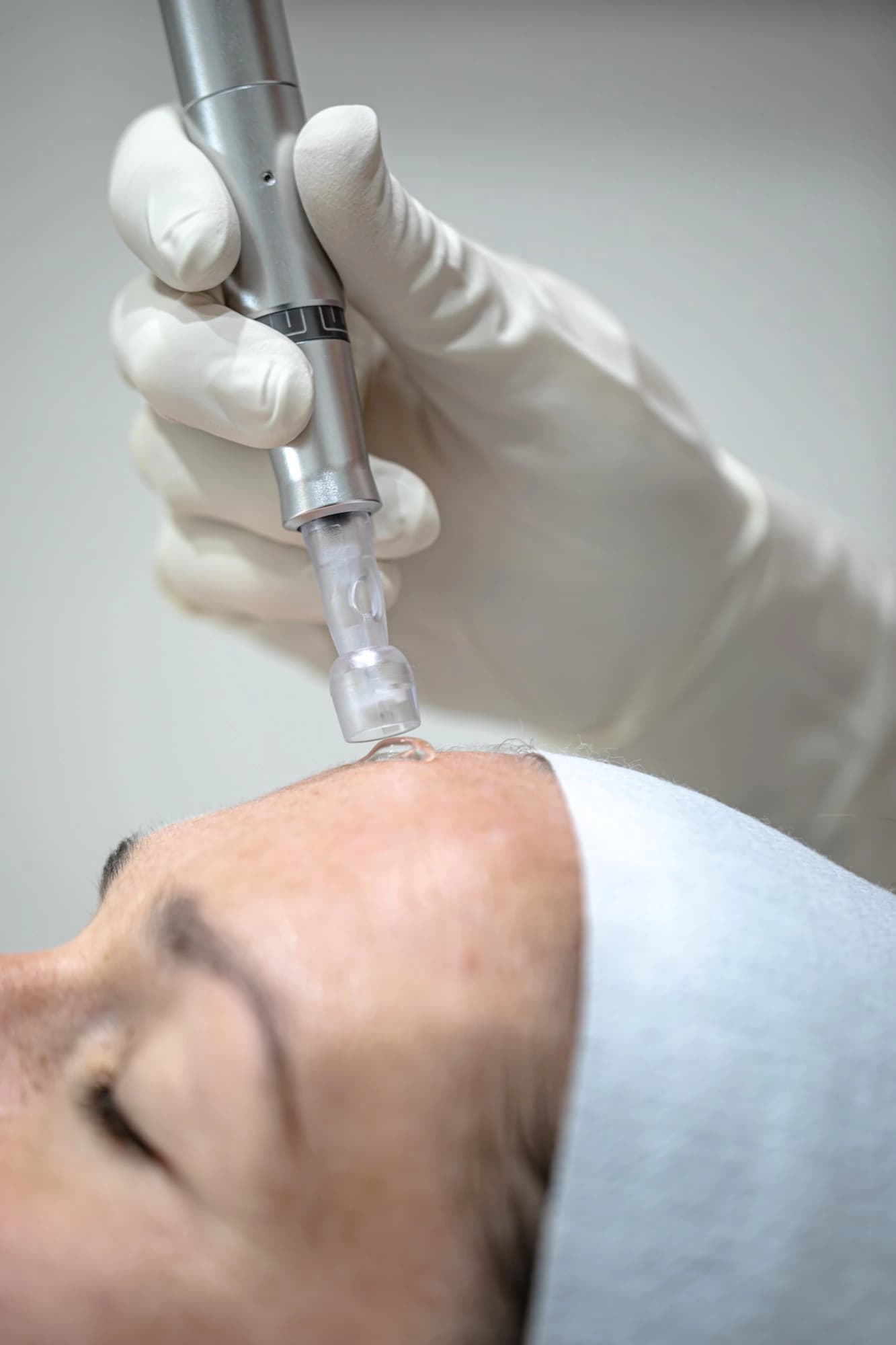 Medical microneedling pen being used on a client's forehead at Classic Skin in Echuca